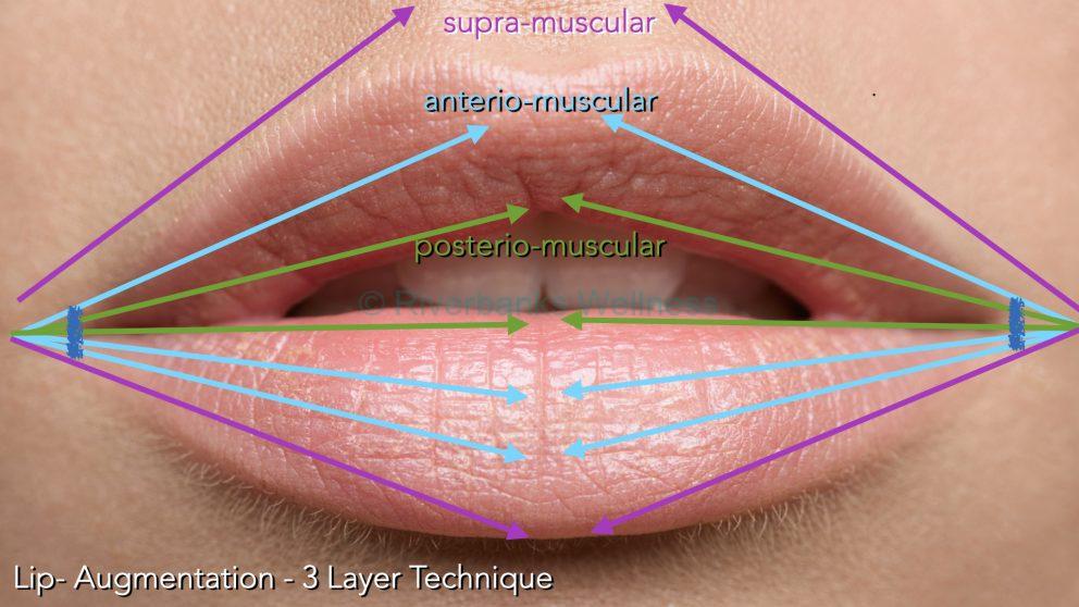 How to choose the best Lip Filler in Harpenden