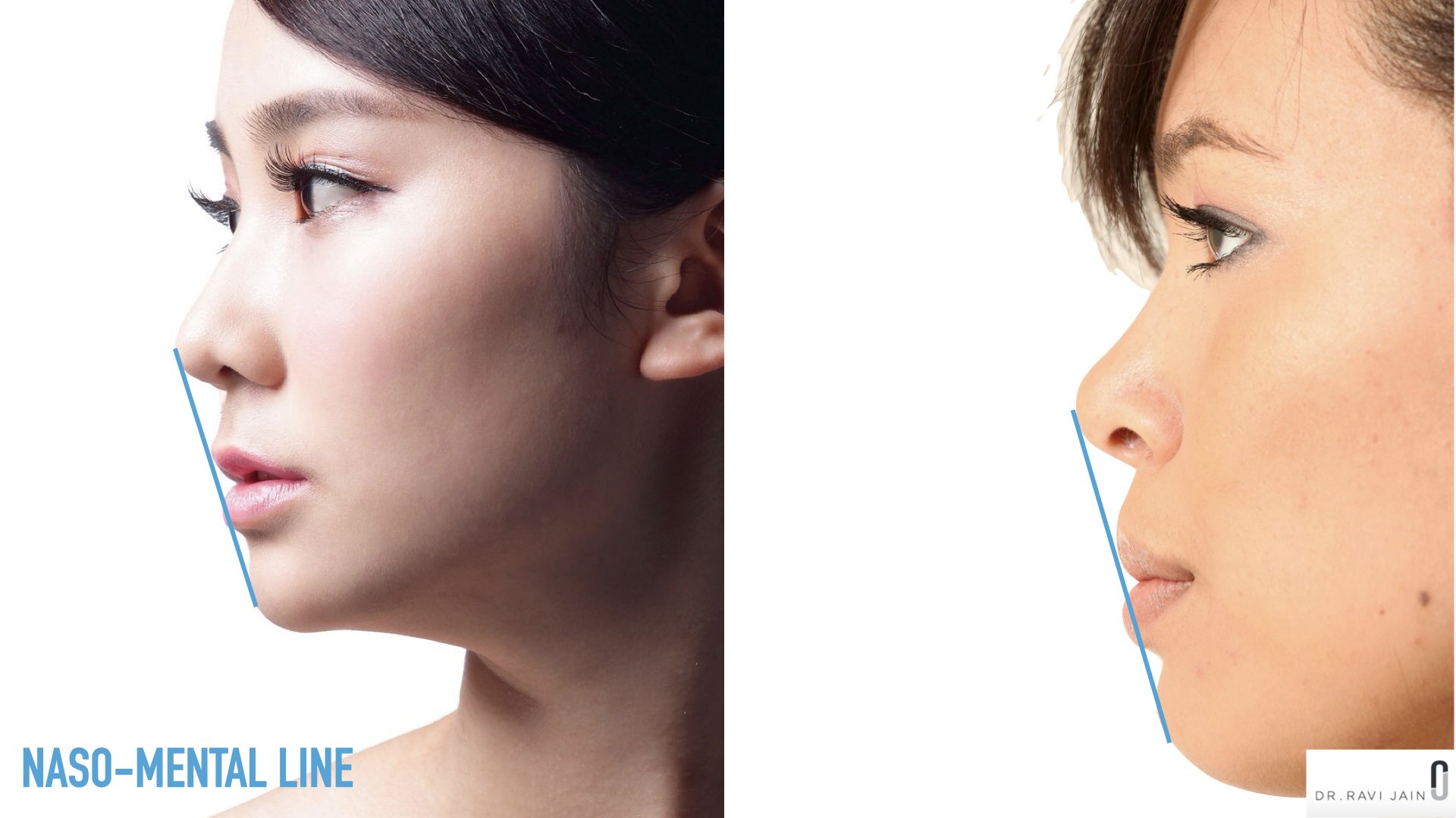 Naso-mental line assessment showing lip projection in relation to nose and chin